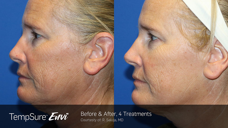 Before and After Photo | TempSure Envi